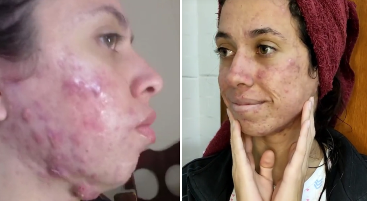 Tiktoker compartilha rotina em tratamento de acne severa