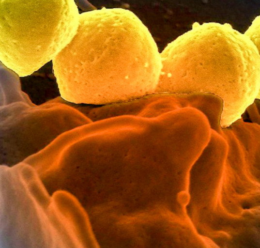 Japão enfrenta aumentos de casos graves de bactéria Streptococcus pyogenes